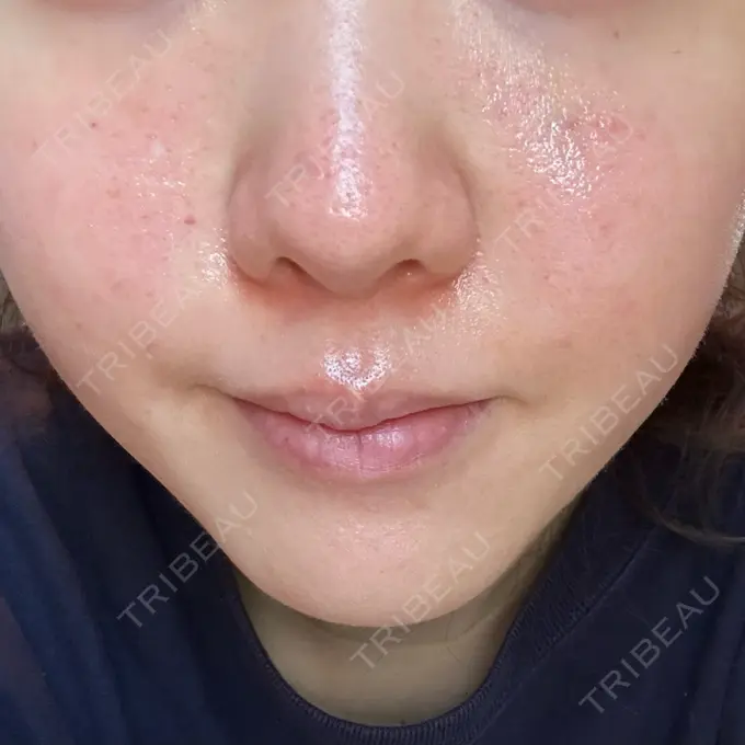 肌育注射（ジュベルックなど） 城本クリニック 池袋院 DAY 2 メイン用