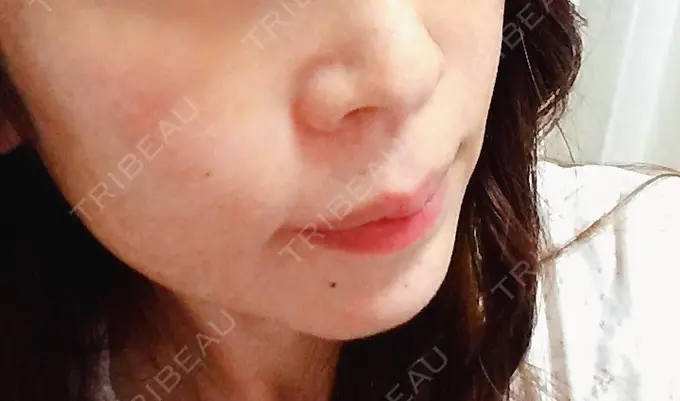 糸リフト / タレ目形成・グラマラスライン（切開） / ボトックス（あご） 品川スキンクリニック広島院 DAY 5 メイン用