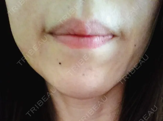 糸リフト / タレ目形成・グラマラスライン（切開） / ボトックス（あご） 品川スキンクリニック広島院 DAY 5 メイン用