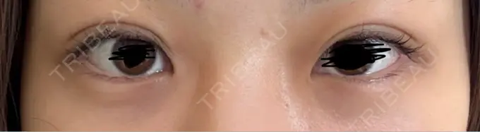 二重埋没 / 目元修正 水の森美容クリニック 東京渋谷院 DAY 7 メイン用