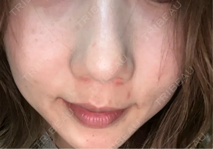 水光注射（ハリ・美肌） / ダーマペン KM新宿クリニック DAY 6 メイン用