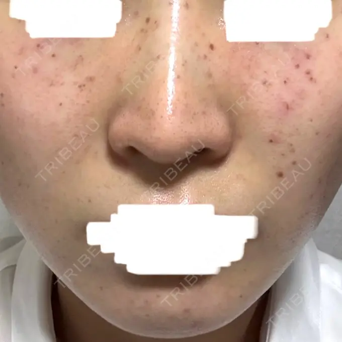 イオン導入 / シミ取りレーザー / ピコレーザートーニング（美白・肝斑） アモーレクリニック 名古屋院 DAY 4 メイン用