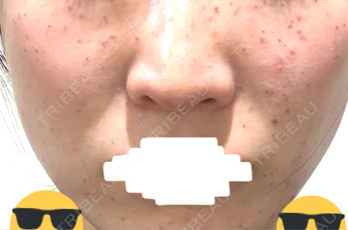 イオン導入 / シミ取りレーザー / ピコレーザートーニング（美白・肝斑） アモーレクリニック 名古屋院 DAY 2 メイン用