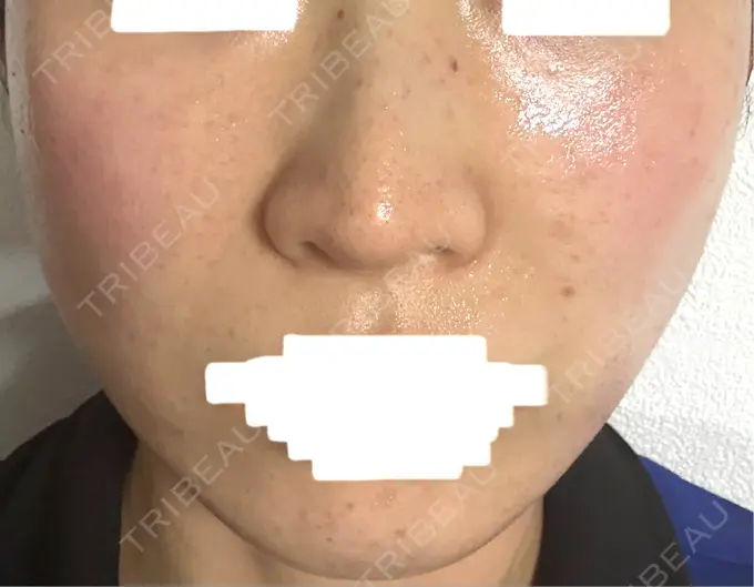 イオン導入 / シミ取りレーザー / ピコレーザートーニング（美白・肝斑） アモーレクリニック 名古屋院 DAY 5 メイン用