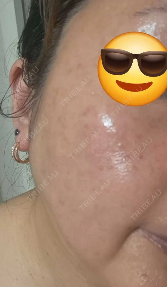 水光注射（ハリ・美肌） しんゆり美容健康クリニック DAY 20 メイン用