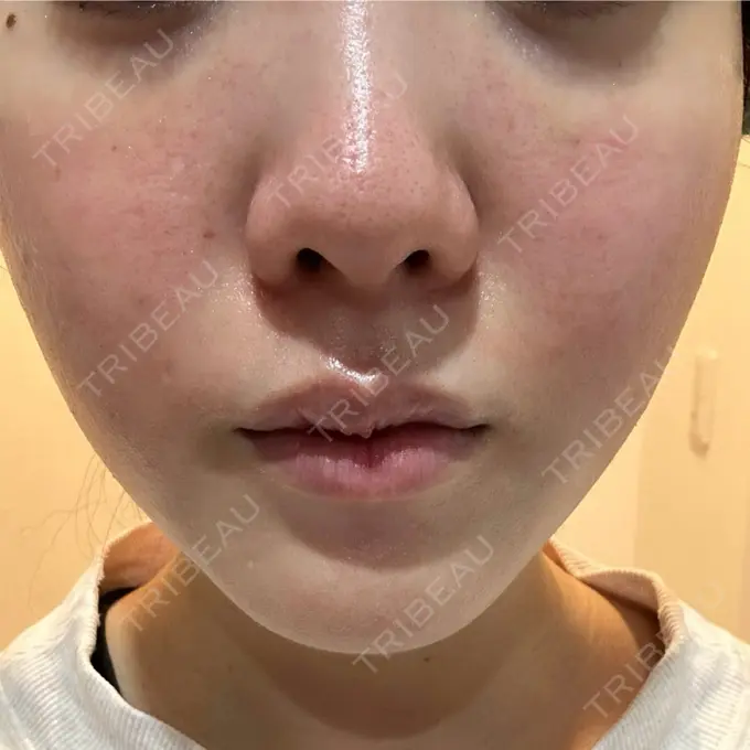 肌育注射（ジュベルックなど） 城本クリニック 池袋院 DAY 3 メイン用