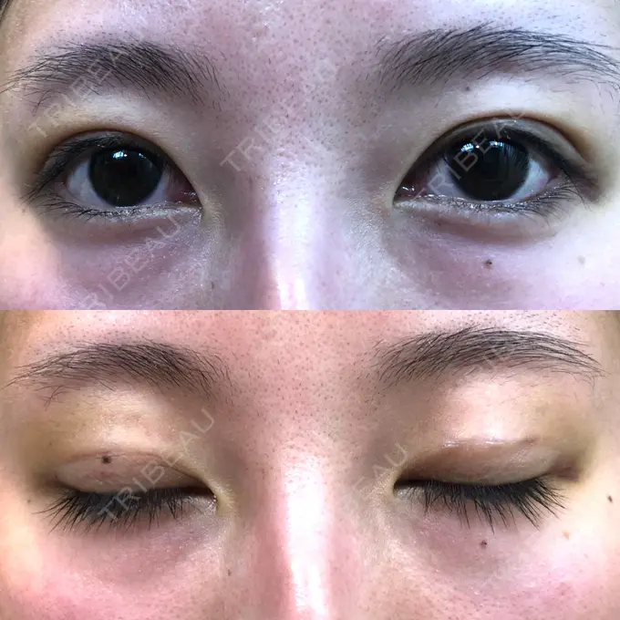 二重埋没 MIYAフェイスクリニック DAY 8 メイン用