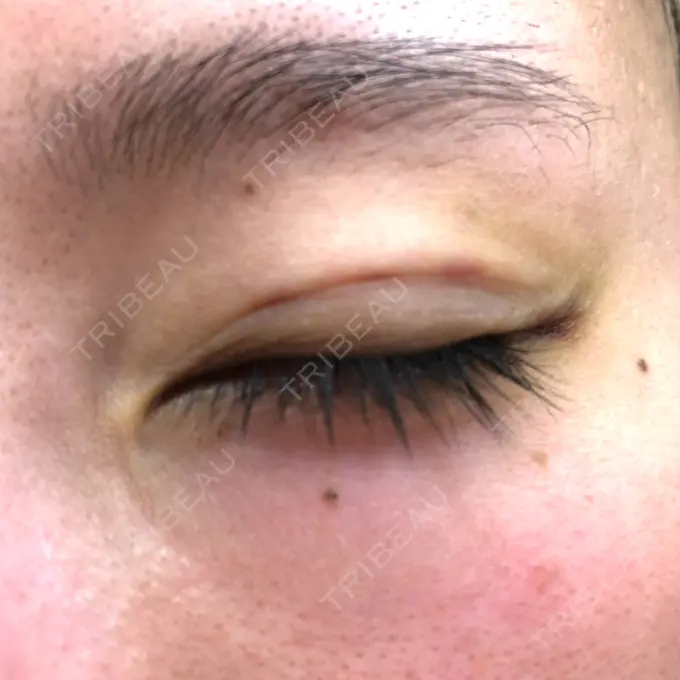 二重埋没 MIYAフェイスクリニック DAY 8 メイン用