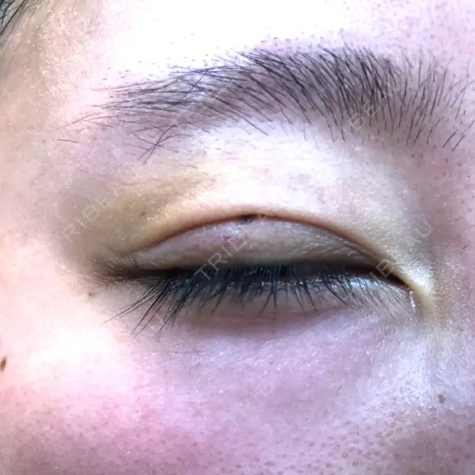 二重埋没 MIYAフェイスクリニック DAY 8 メイン用