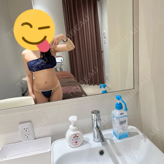 脂肪吸引（お腹） / 豊胸（脂肪注入） / 脂肪吸引（腰） Mods Clinic（モッズクリニック） 名古屋院 DAY 181 メイン用