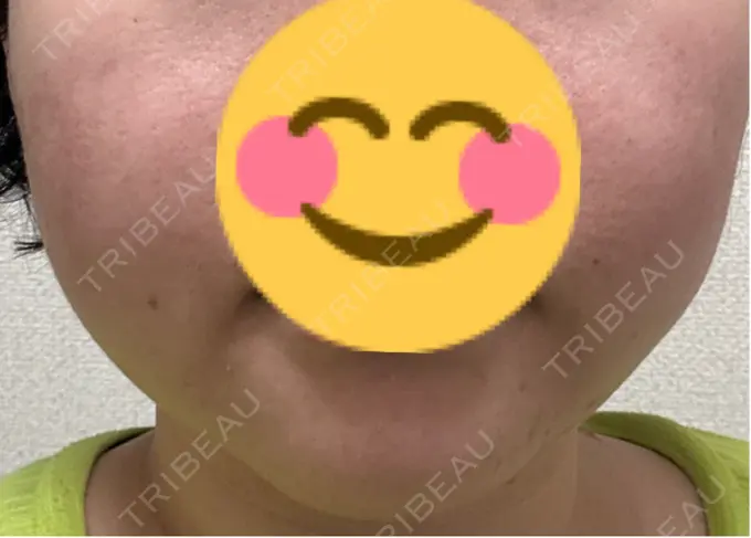 RF（高周波）たるみ治療 Clinic K Blossom DAY 7 メイン用