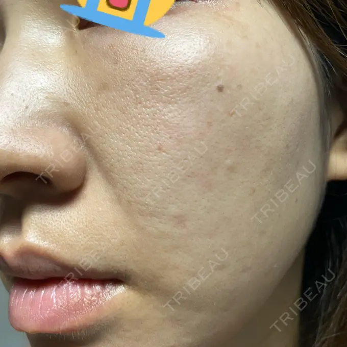 ヒアルロン酸注入（鼻） / ヒアルロン酸注入（頬） 百人町アルファクリニック DAY 25 メイン用