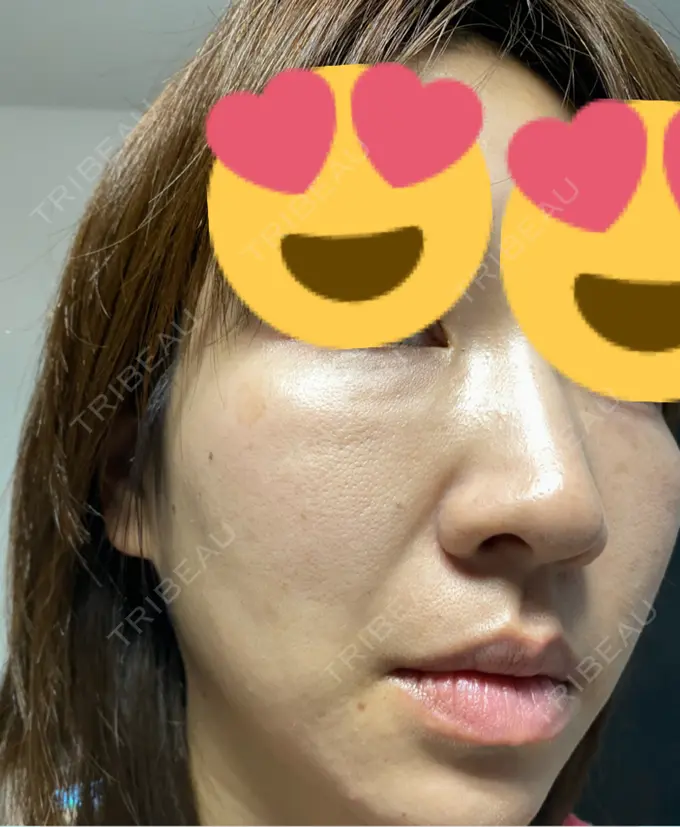 ヒアルロン酸注入（鼻） / ヒアルロン酸注入（頬） 百人町アルファクリニック DAY 25 メイン用