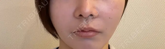 ヒアルロン酸注入（鼻翼基部） DMTC CLINIC 日本橋院 DAY 1 メイン用