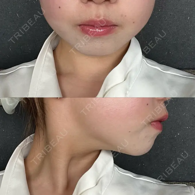 RF（高周波）たるみ治療 大美会クリニック 梅田院 DAY 18 メイン用