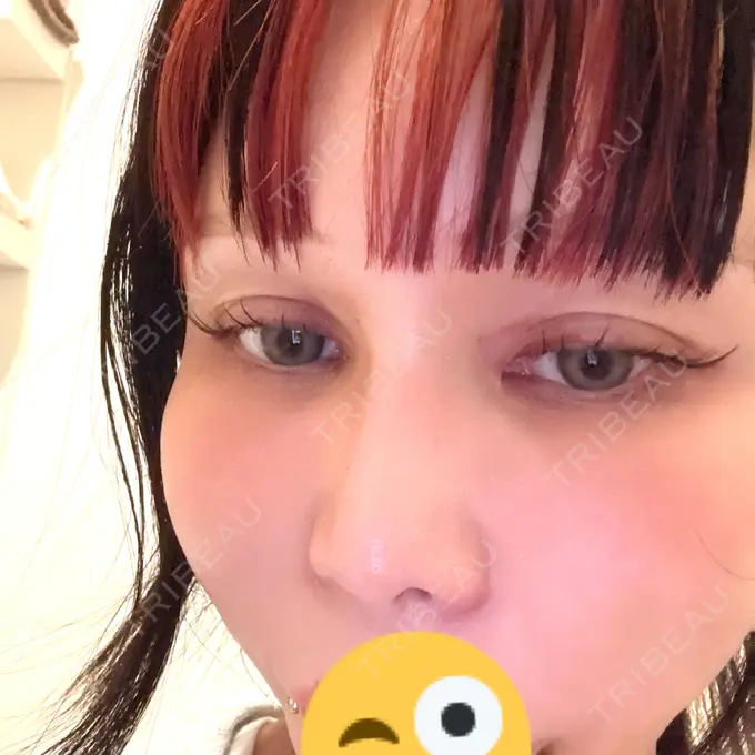 小鼻縮小（非切開） 形成外科と美容外科のクリニック池袋 DAY 3 メイン用