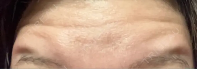 ボトックス（額） 湘南美容クリニック 名古屋駅本院 DAY 2 メイン用