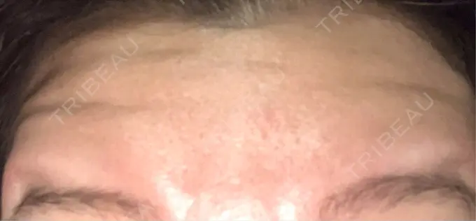 ボトックス（額） 湘南美容クリニック 名古屋駅本院 DAY 3 メイン用