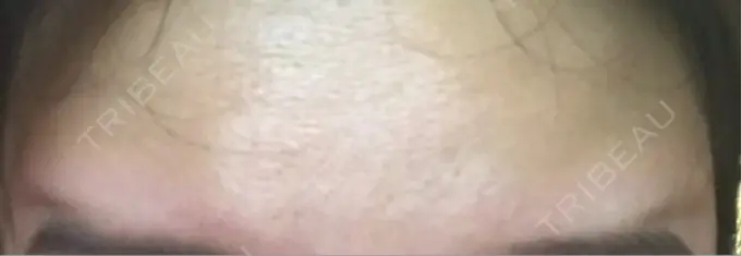 ボトックス（額） 湘南美容クリニック 名古屋駅本院 DAY 5 メイン用