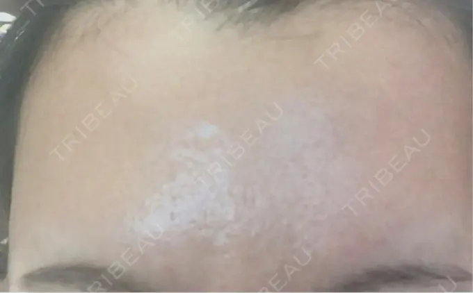 ボトックス（額） 湘南美容クリニック 名古屋駅本院 DAY 7 メイン用