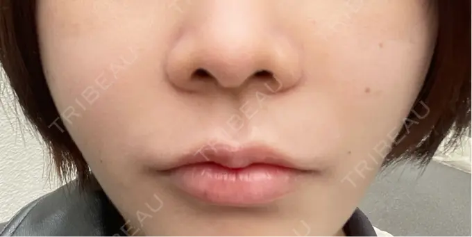 ヒアルロン酸注入（鼻翼基部） DMTC CLINIC 日本橋院 AFTER メイン用