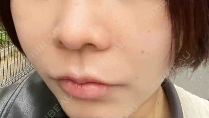 ヒアルロン酸注入（鼻翼基部） DMTC CLINIC 日本橋院 DAY 2 メイン用