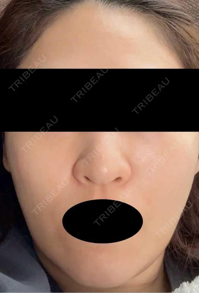 ピーリング（ハリ・ツヤ） VERDE CLINIC お茶の水（ベルデクリニックお茶の水） DAY 5 メイン用