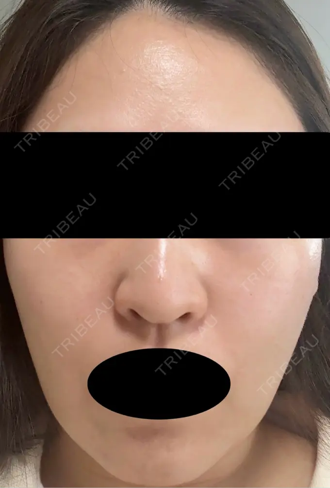 ピーリング（ハリ・ツヤ） VERDE CLINIC お茶の水（ベルデクリニックお茶の水） DAY 7 メイン用