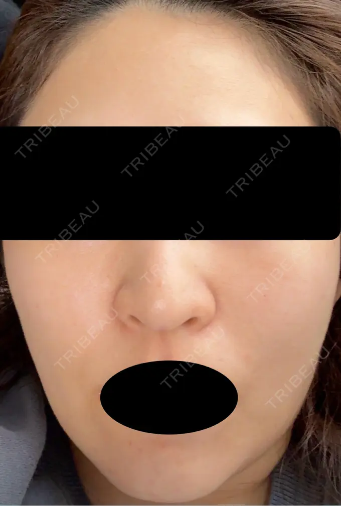 ピーリング（ハリ・ツヤ） VERDE CLINIC お茶の水（ベルデクリニックお茶の水） DAY 6 メイン用