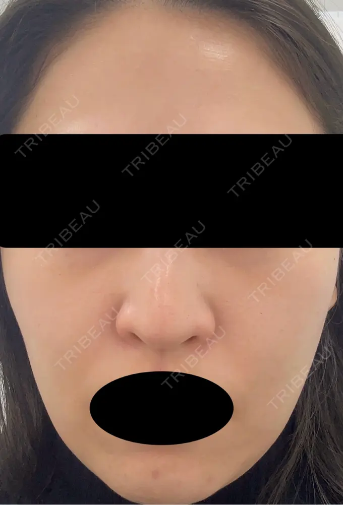 ピーリング（ハリ・ツヤ） VERDE CLINIC お茶の水（ベルデクリニックお茶の水） DAY 8 メイン用