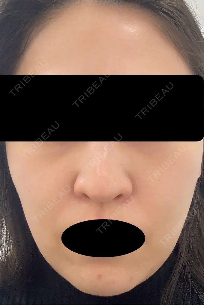 ピーリング（ハリ・ツヤ） VERDE CLINIC お茶の水（ベルデクリニックお茶の水） AFTER メイン用