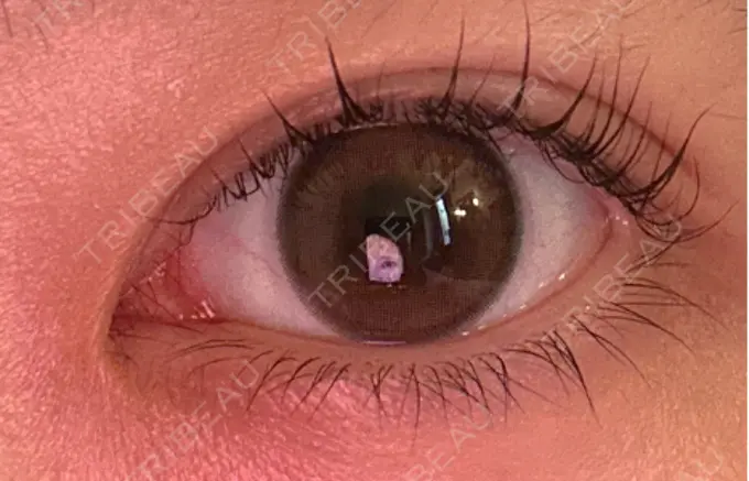 二重埋没 仙台N美容クリニック AFTER メイン用