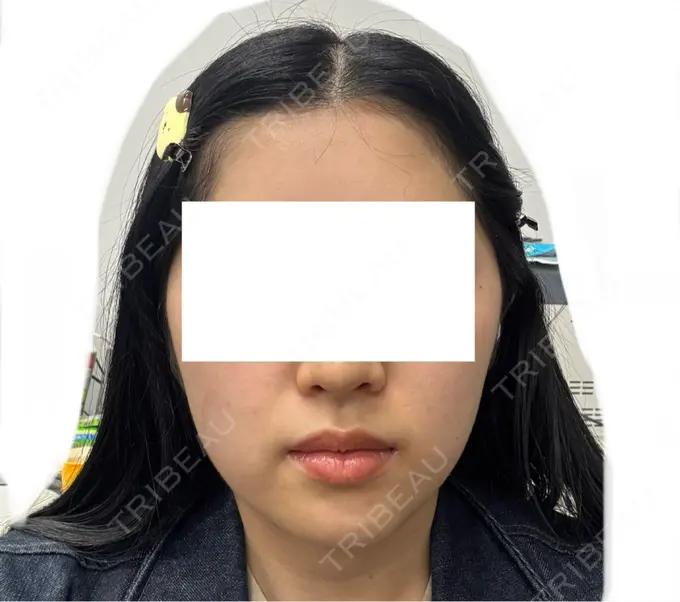 RF（高周波）たるみ治療 Clinic K Blossom DAY 0 メイン用