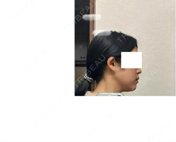 RF（高周波）たるみ治療 Clinic K Blossom DAY 0 メイン用