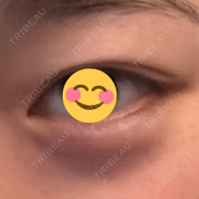 ヒアルロン酸注入（涙袋） フィラークリニック 町田院 AFTER メイン用