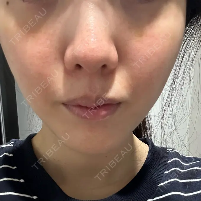 肌育注射（ジュベルックなど） 城本クリニック 池袋院 DAY 5 メイン用