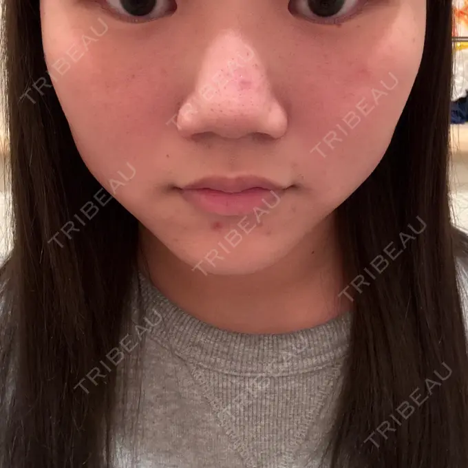 RF（高周波）たるみ治療 RIVER CLINIC（リバークリニック） DAY 38 メイン用