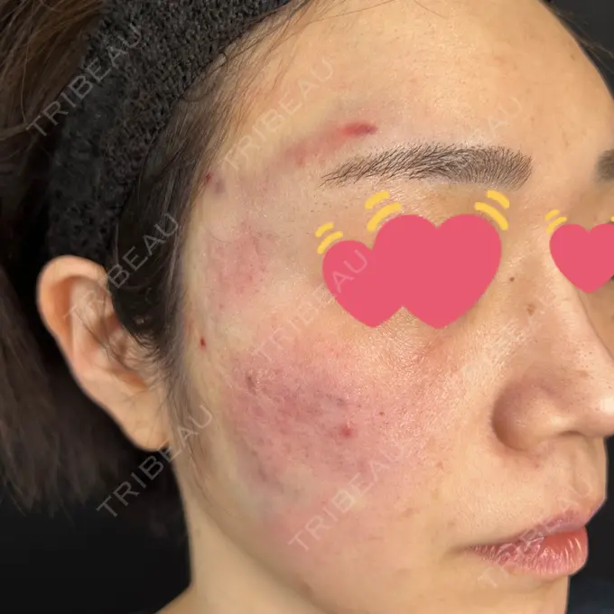 サブシジョン 藤・ナチュレ美容クリニック 銀座院 DAY 0 メイン用