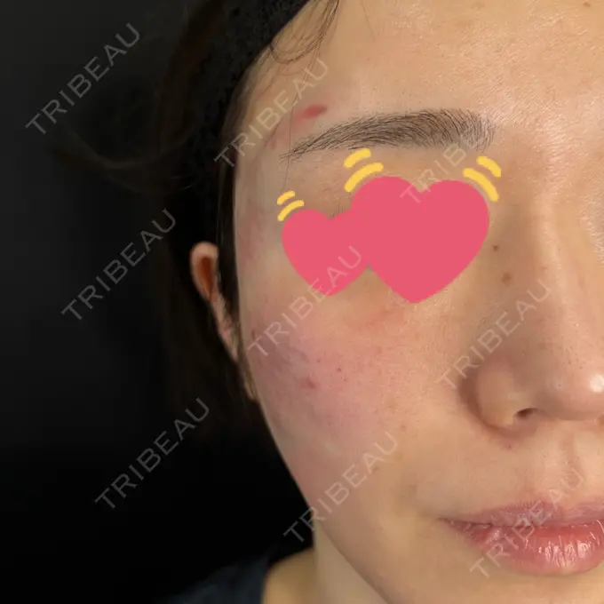 サブシジョン 藤・ナチュレ美容クリニック 銀座院 DAY 0 メイン用