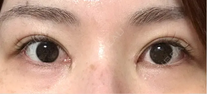 二重埋没 / 目頭切開 / その他（目元） eクリニック 福岡院 DAY 27 メイン用