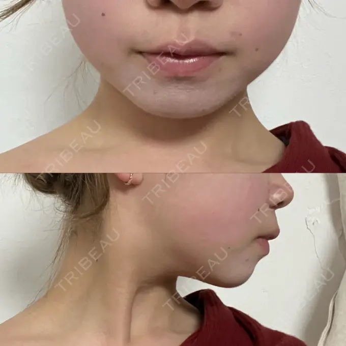 RF（高周波）たるみ治療 大美会クリニック 梅田院 DAY 21 メイン用