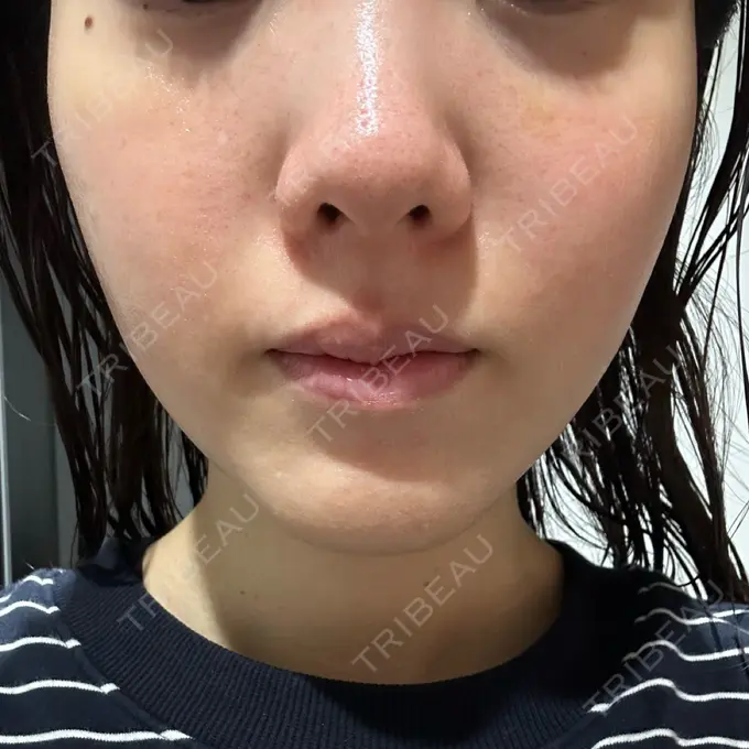 肌育注射（ジュベルックなど） 城本クリニック 池袋院 DAY 7 メイン用