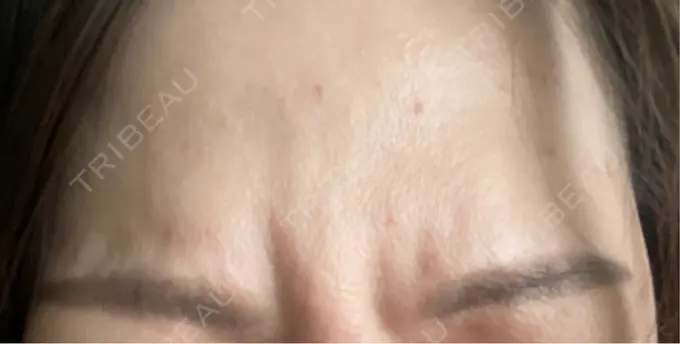 ボトックス（眉間） / ボトックス（額） / その他（肌） TCB東京中央美容外科 新横浜院 AFTER メイン用