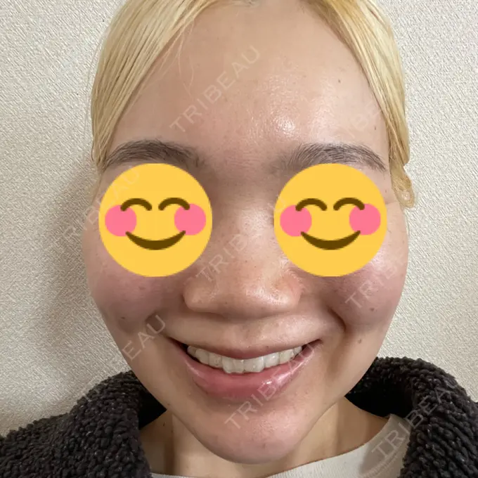 糸リフト / バッカルファット除去 / 脂肪吸引（顔） / メーラーファット除去 / ジョールファット除去 / 脂肪溶解注射（顔） RIVER CLINIC（リバークリニック） DAY 31 メイン用