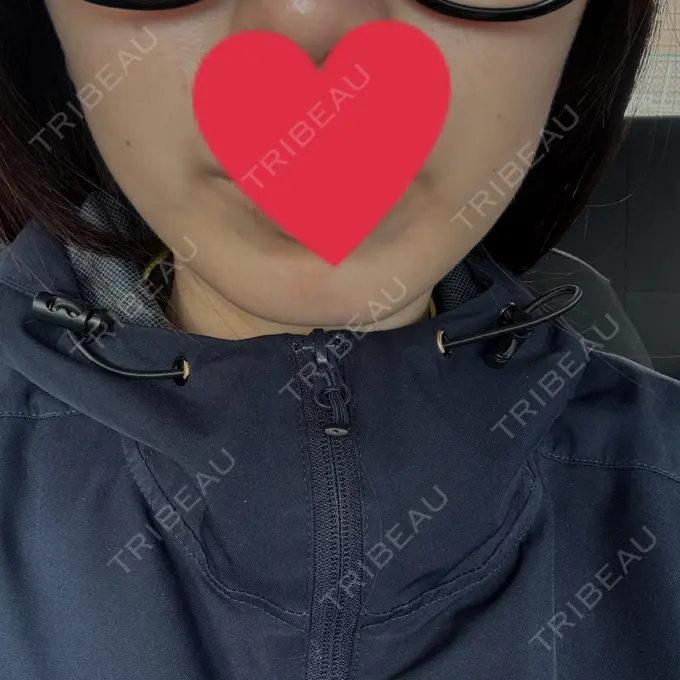 ボトックス（エラ・小顔） 共立美容外科 名古屋院 AFTER メイン用