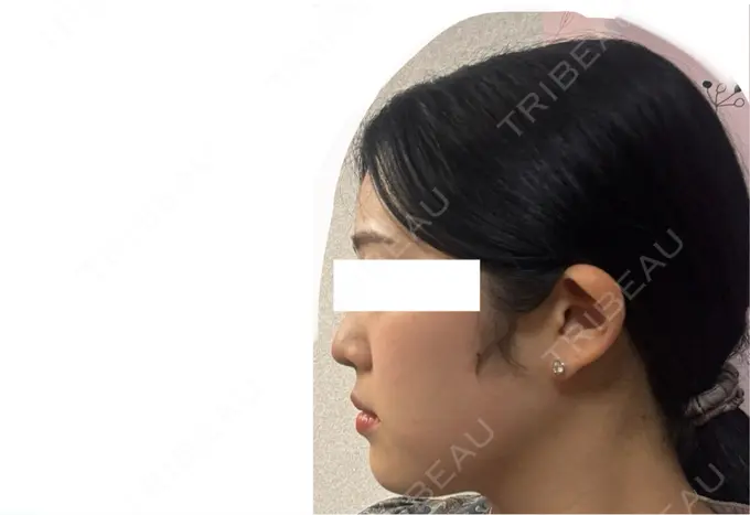 RF（高周波）たるみ治療 Clinic K Blossom AFTER メイン用