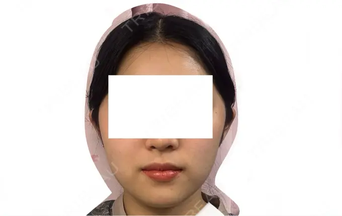 RF（高周波）たるみ治療 Clinic K Blossom DAY 6 メイン用