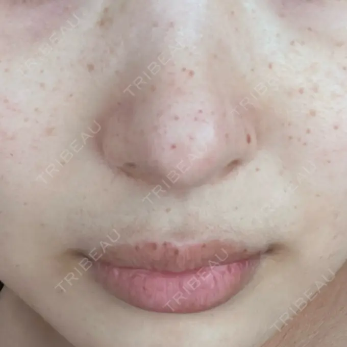 ルメッカ ルラ美容クリニック 岡山院 AFTER メイン用