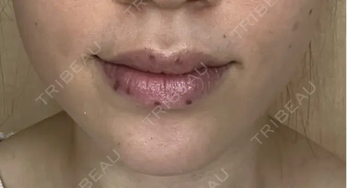 シミ取りレーザー / その他（口元） Wクリニック 梅田院 DAY 2 メイン用