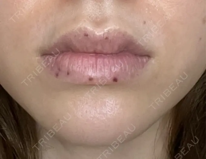 シミ取りレーザー / その他（口元） Wクリニック 梅田院 DAY 3 メイン用